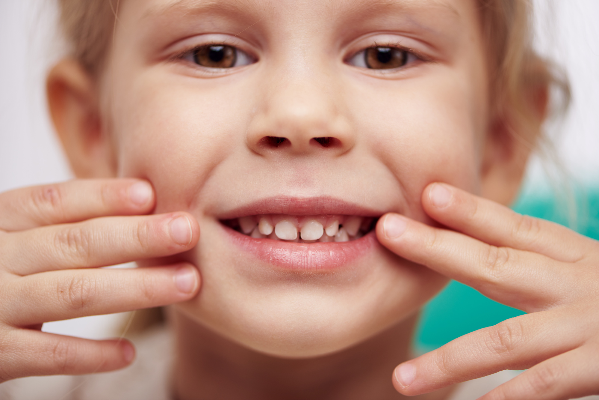 cavities in children